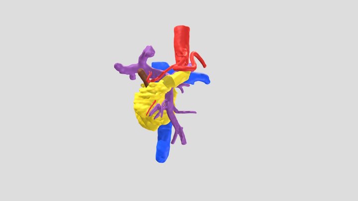 Modelo digital 3D de un caso de cáncer de páncreas