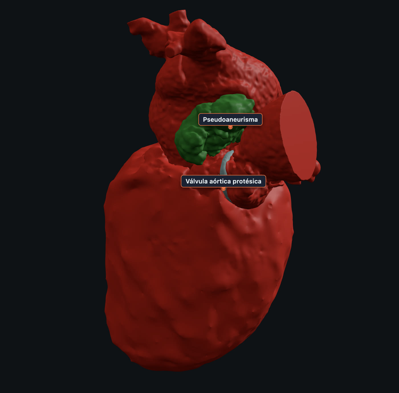 Modelo digital 3D interactivo de un caso vascular